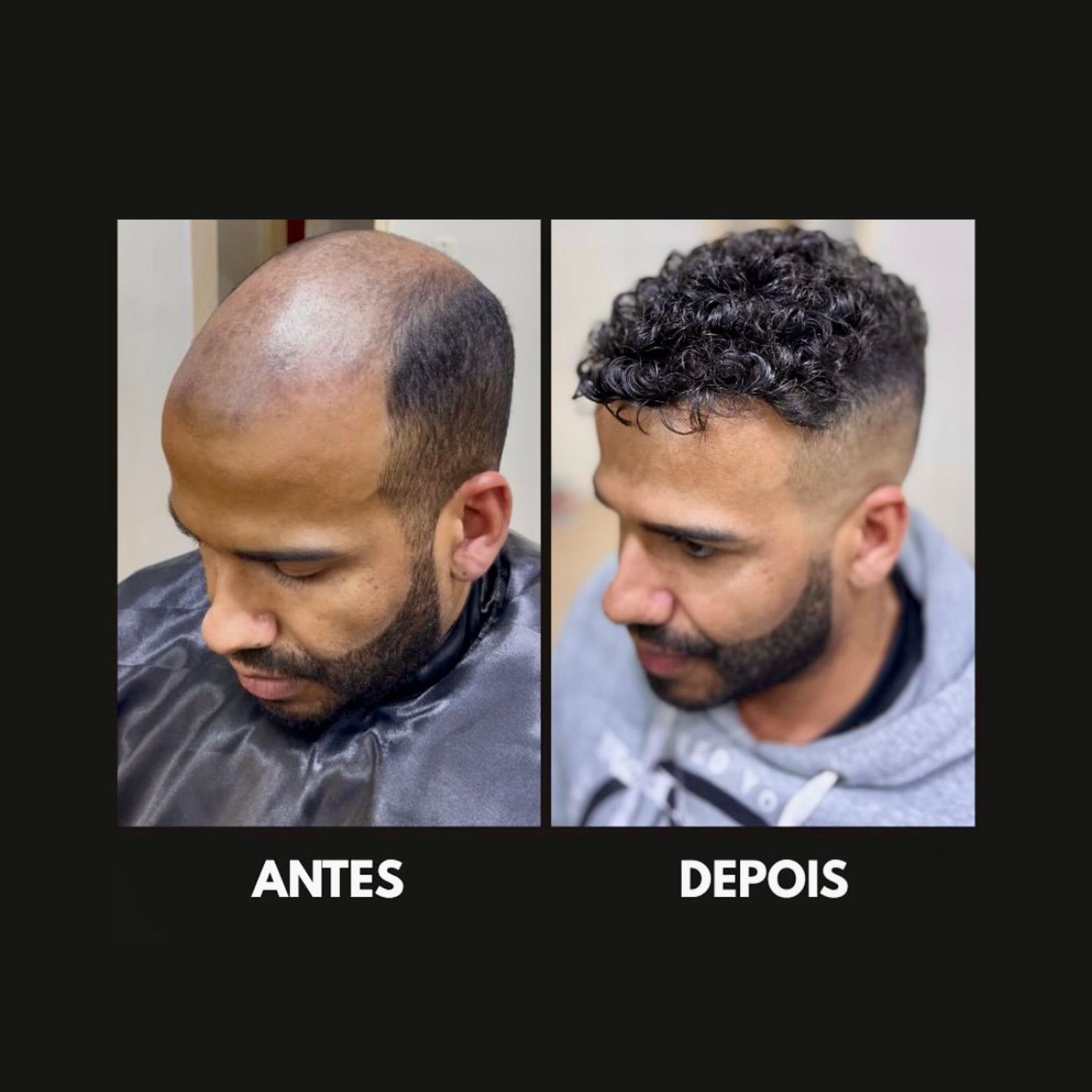 Antes e Depois Prótese Capilar Masculina São Roque