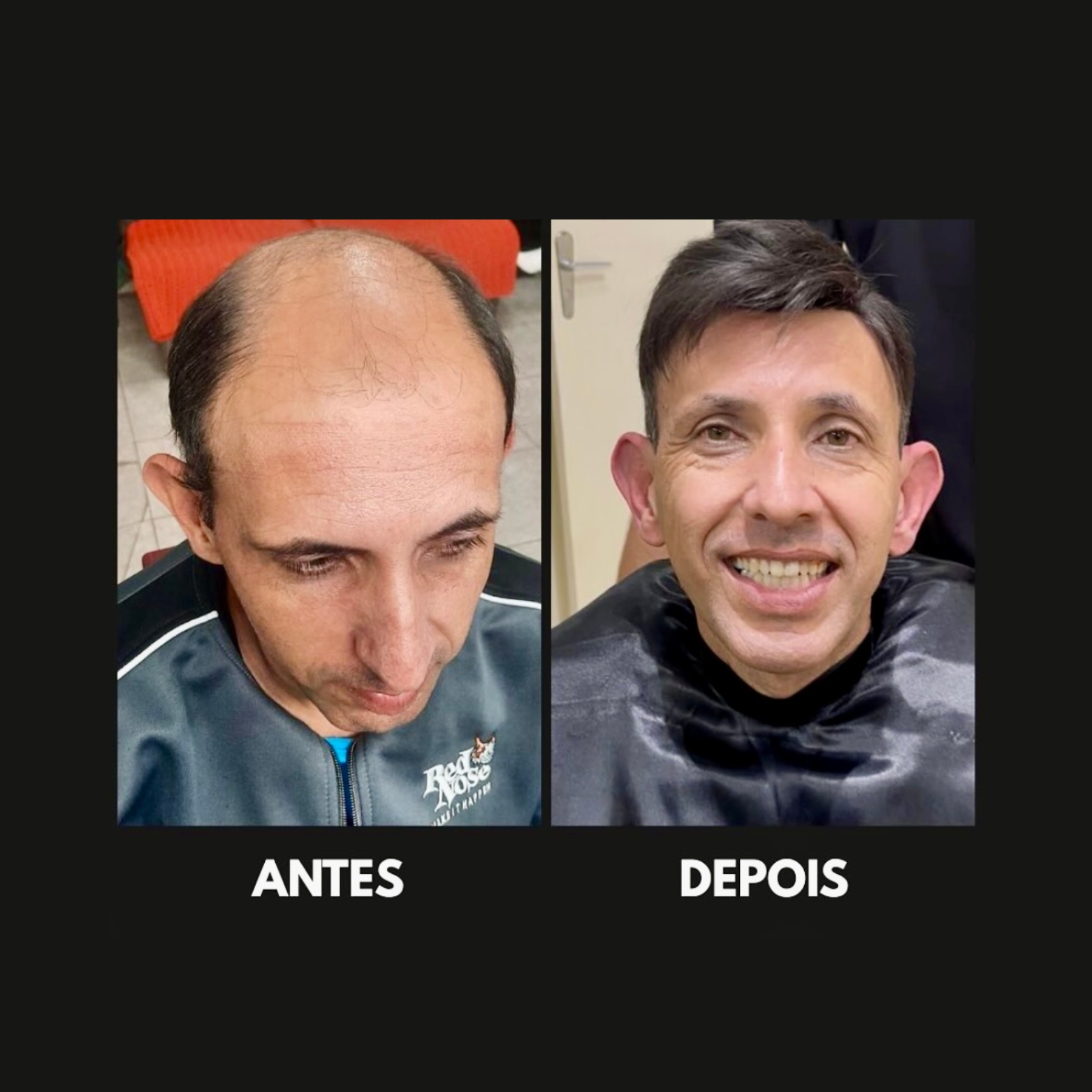 Transformação Visual com Prótese Capilar Indetectável