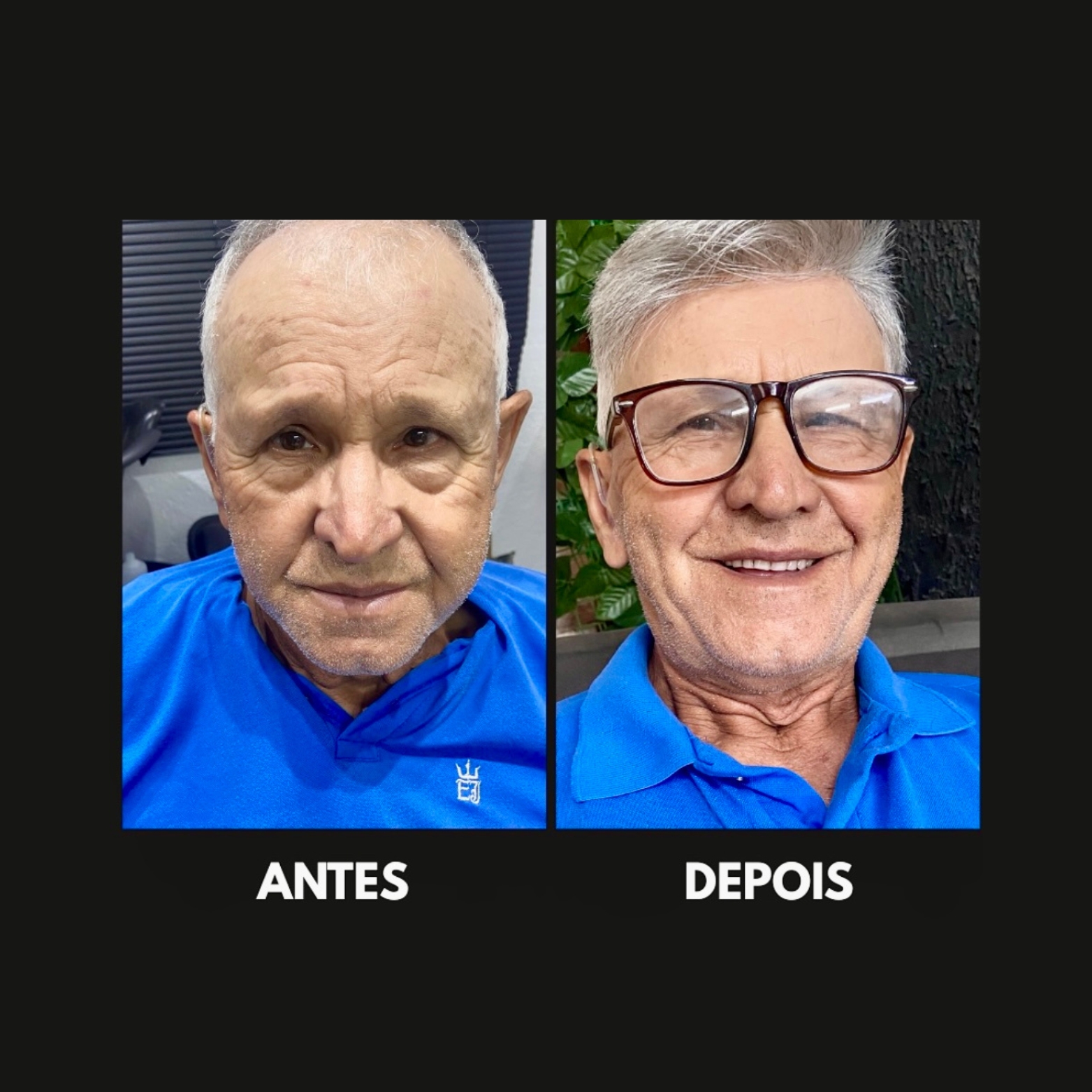 Prótese Capilar Micropele Resultado Natural