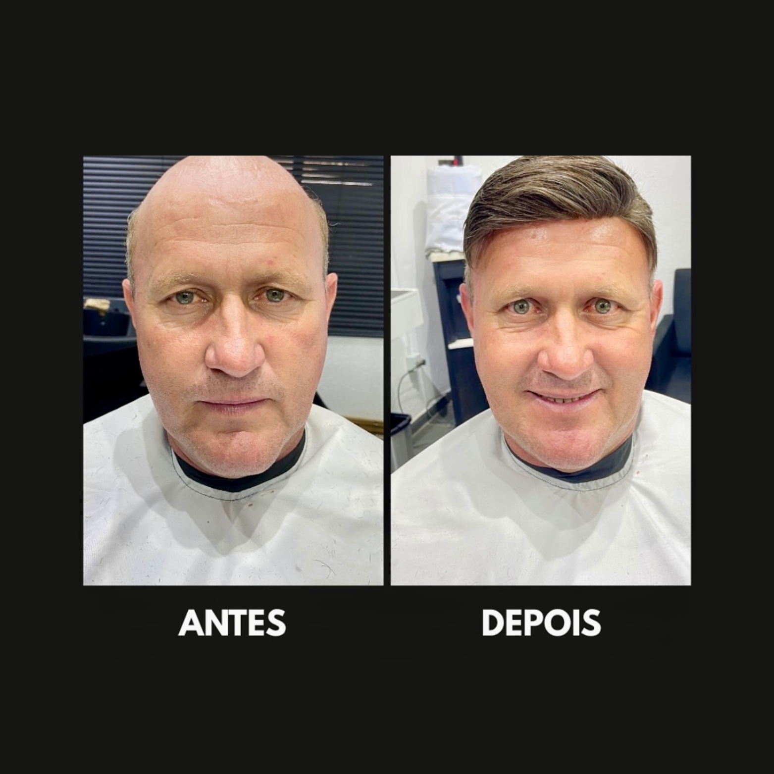 Correção de Calvície Masculina sem Cirurgia