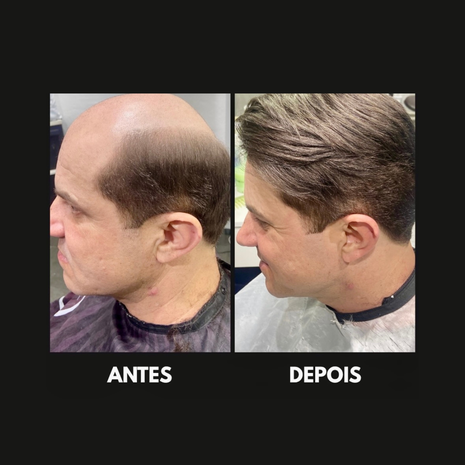 Cliente Satisfeito com Prótese Capilar em SP